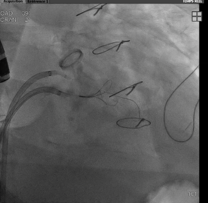 CSaintEtienne's tweet photo. First case of trans-septal LAMPOON in our center @CHRU_Tours with great success. Thanks to all the team @ClercJeanMichel @BernardAnne7 for this nice job and to @CathElectroSurg for inventing this great technic https://t.co/BzPuwRDnIO