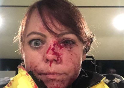 RoamingRoyston's tweet image. Horrific injuries suffered by police officer in brutal city centre attack edp24.co.uk/news/crime/man… #ProtectTheProtectors