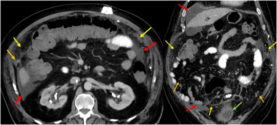 European Urology Open Science (@eururolopen) on Twitter photo Percutaneous Biopsy Tract Seeding in a Patient with Muscle-invasive Bladder Cancer
@agusevmed <a href="/DaveShubha/">Shubha Dave</a>
eu-openscience.europeanurology.com/article/S2666-… Percutaneous Biopsy Tract Seeding in a Patient with Muscle-invasive Bladder Cancer
@agusevmed <a href="/DaveShubha/">Shubha Dave</a>
eu-openscience.europeanurology.com/article/S2666-…