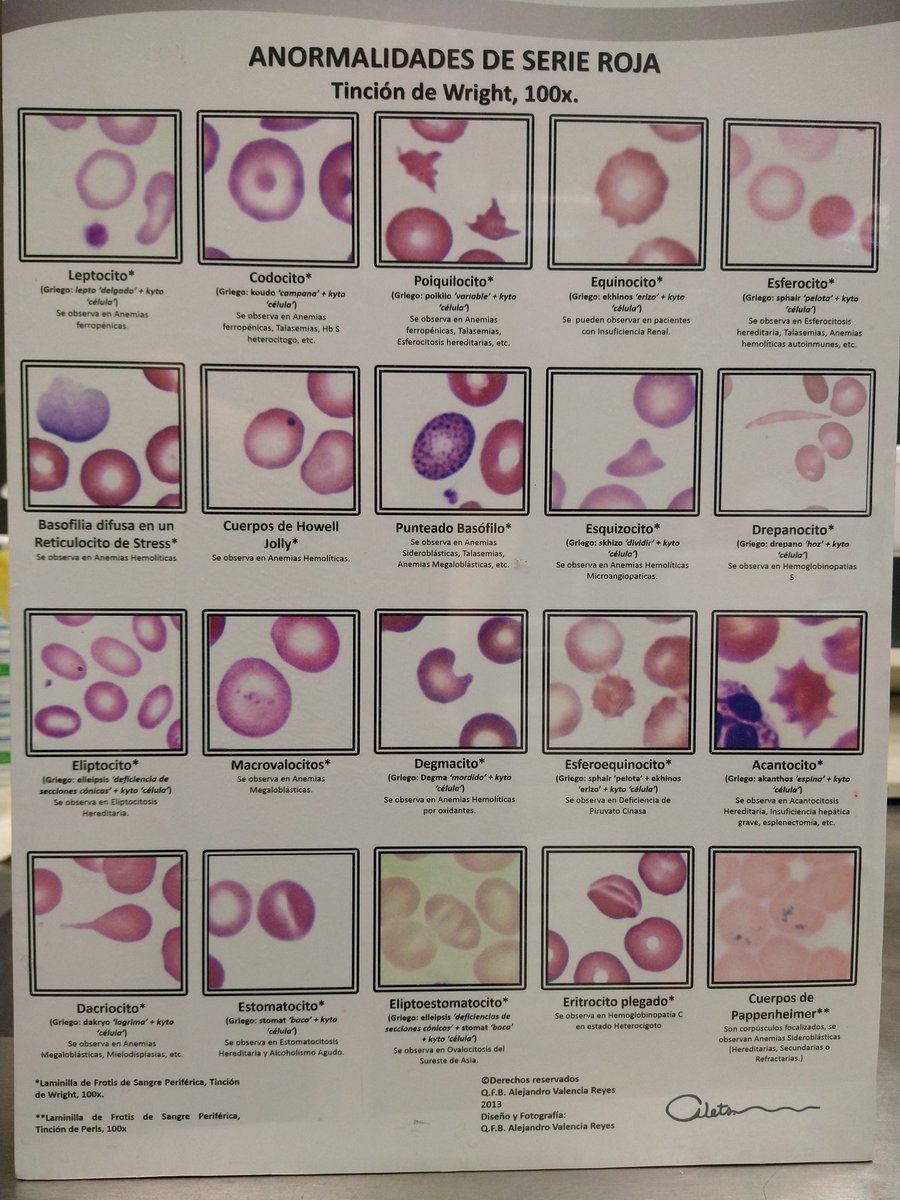 En cuanto a la morfología de los eritrocitos encontramos abundantes leptositos, codocitos, esferocitos y dacriocitos, propios de Anemia por deficiencia de hierro, anemia megaloblástica o anemia hemolitica pero SIN anemia.