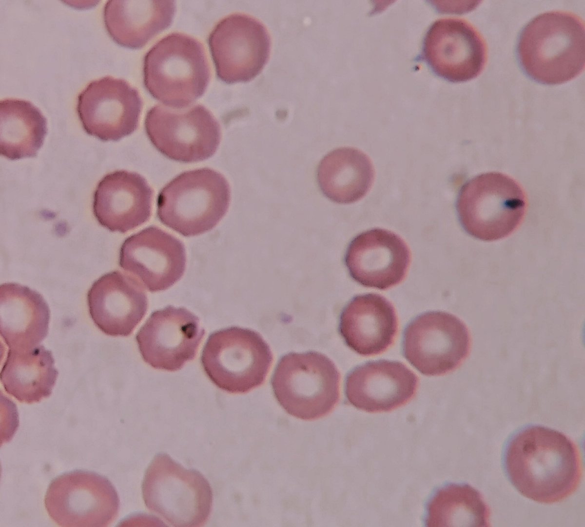 El paciente no tiene anemia, pero su eritrocitos tienen las características morfológicas de una deficiencia de hierro. Significa que los eritrocitos no están transportando suficiente hemoglobina por algún motivo diferente a la deficiencia de hierro, el motivo es la Babesia.