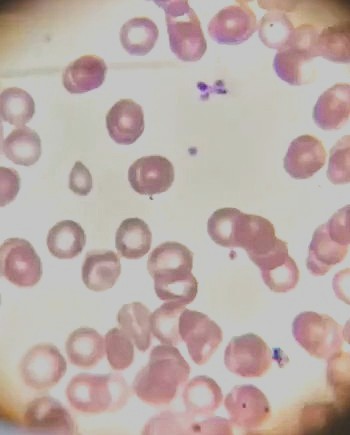 El paciente no tiene anemia, pero su eritrocitos tienen las características morfológicas de una deficiencia de hierro. Significa que los eritrocitos no están transportando suficiente hemoglobina por algún motivo diferente a la deficiencia de hierro, el motivo es la Babesia.