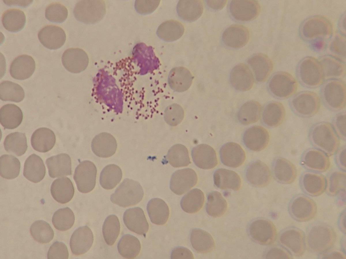 Los leucocitos que nos defienden de parásitos son los Eosinofilo. Observamos como liberan sus granulaciones sobre los eritrocitos infectados comprobando la presencia de parásitos.