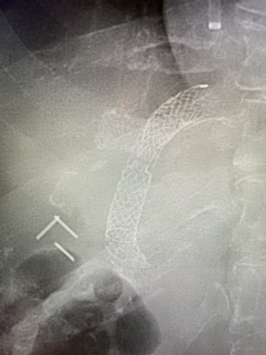 Kyle Cooper (@kylecoopermd) on Twitter photo One of my favorite procedures to perform. <a href="/SIRRFS/">SIR RFS</a> <a href="/TraineesBSIR/">BSIR Trainees (British Society of IR Trainees)</a> what is going on here and why? #irad <a href="/LLUMedCenter/">Loma Linda U. Med Ctr</a> <a href="/SIRspecialists/">Society of Interventional Radiology</a> <a href="/cirsesociety/">CIRSE</a> <a href="/BSIR_News/">The British Society of Interventional Radiology</a> <a href="/MiamiVasc/">Miami Vascular</a> <a href="/Saad_VIR/">Wael Saad</a> <a href="/WLGoreMedical/">WLGoreMedical</a> One of my favorite procedures to perform. <a href="/SIRRFS/">SIR RFS</a> <a href="/TraineesBSIR/">BSIR Trainees (British Society of IR Trainees)</a> what is going on here and why? #irad <a href="/LLUMedCenter/">Loma Linda U. Med Ctr</a> <a href="/SIRspecialists/">Society of Interventional Radiology</a> <a href="/cirsesociety/">CIRSE</a> <a href="/BSIR_News/">The British Society of Interventional Radiology</a> <a href="/MiamiVasc/">Miami Vascular</a> <a href="/Saad_VIR/">Wael Saad</a> <a href="/WLGoreMedical/">WLGoreMedical</a>