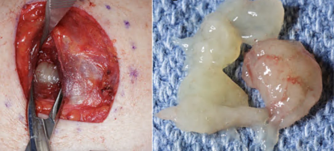 High grade primary synovial sarcoma originating from the anterior MV leaflet with near complete obstruction of the LVOT and metastatic skin nodules.  Treatment = resection, MVR, followed by aggressive adjuvant chemotherapy.  This profession constantly humbles me.