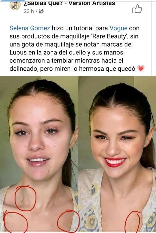 lupus discoide