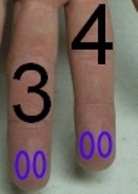 "Avoid areas of the finger that are cold, swollen, inflamed, calloused" (=hardened) "or cyanotic" (=interesting one, a separate thread for the same). "The bottom image indicates the correct area to use for skin puncture."Source:  https://www.labce.com/spg296239_using_the_fingers_for_dermal_puncture.aspx