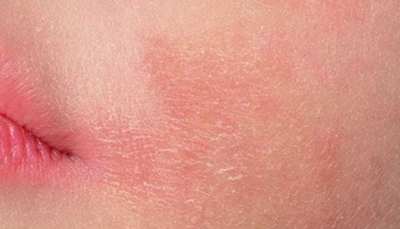 ⚠️ ทายาสิว แล้วผิวแห้ง แดง ลอก แสบ ⚠️
คนเป็นสิวต้องเคยเจอปัญหานี้

📌สาเหตุ เพราะ
1. โครงสร้างผิวของคนเป็นสิว จะหน้ามัน แต่ผิวขาดน้ำ
2. ยาทาสิวแทบทุกตัว ระคายเคืองผิว

🚨 การเติมน้ำให้กับผิว “สำคัญมาก” ควรเลือก skincare ที่ให้ความชุ่มชื้นพิเศษตลอดทั้งวัน