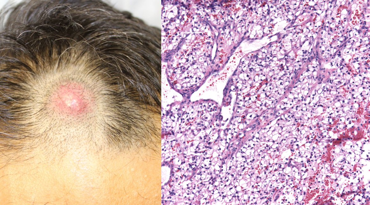 ChristineJKoMD's tweet photo. What's your diagnosis? Short video answer at https://t.co/dy4T44h4Gd #dermtwitter #dermpath https://t.co/lBwIijBNJu