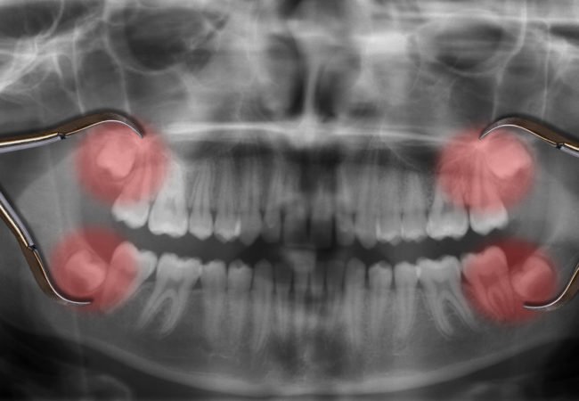 Wisdom teeth are vestigial molars that human ancestors used to grind down plant tissue. The skulls of human ancestors had larger jaws with more teeth & as human diets changed, smaller jaws were naturally selected, yet the 3rd molars still commonly develop  http://ow.ly/nMae30oikb5 