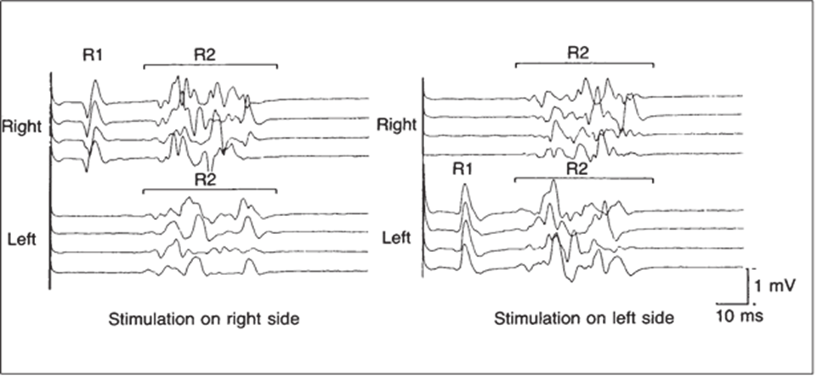 ClinicalNeuroph's tweet photo. [Neuromuscular electrodiagnostic glossary] Blink Reflex (Blink Responses). 

https://t.co/h5OJrOmGkU
@AANEMorg
#BlinkReflex #BlinkResponses #Neuromuscular #Clinicalneuroph https://t.co/sl57OSxoal