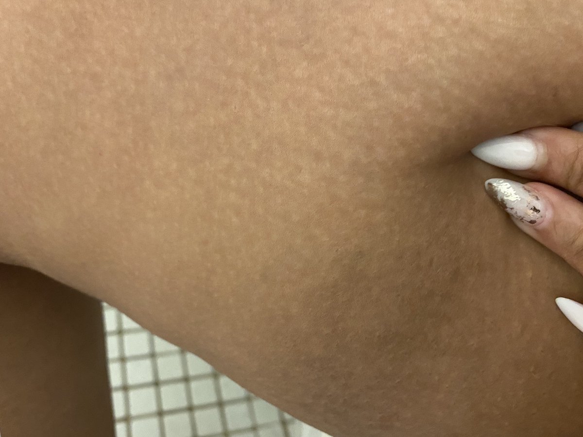 CinnSoSmoked's tweet photo. I’ve said multiple times it’s fun having thick thighs till the chaffing starts. Chaffing led to hyperpigmentation between my thighs and lord did I hate it. Thanks to @MakeupForWOC I was able to lighten them without breaking bank.  

A thread. https://t.co/YKuI3szt6G