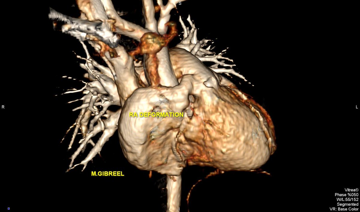 MGibreel1's tweet image. Subsequent chamber deformation :
Two patients,,, 
RV &amp;amp; RA geometric deformation in pectus excavatum,,, 
From my archive