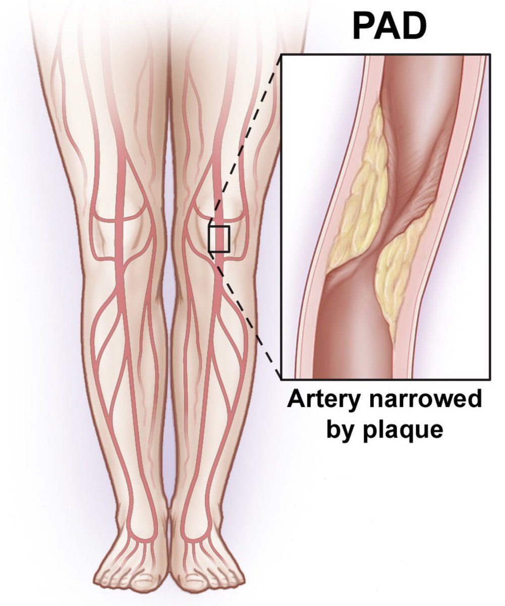 September is Peripheral Arterial Disease Awareness Month! PAD is a chronic circulatory condition involving reduced blood flow to the limbs due to a narrowing of blood vessels. By raising awareness, we can diagnose and treat patients sooner to prevent avoidable amputations.