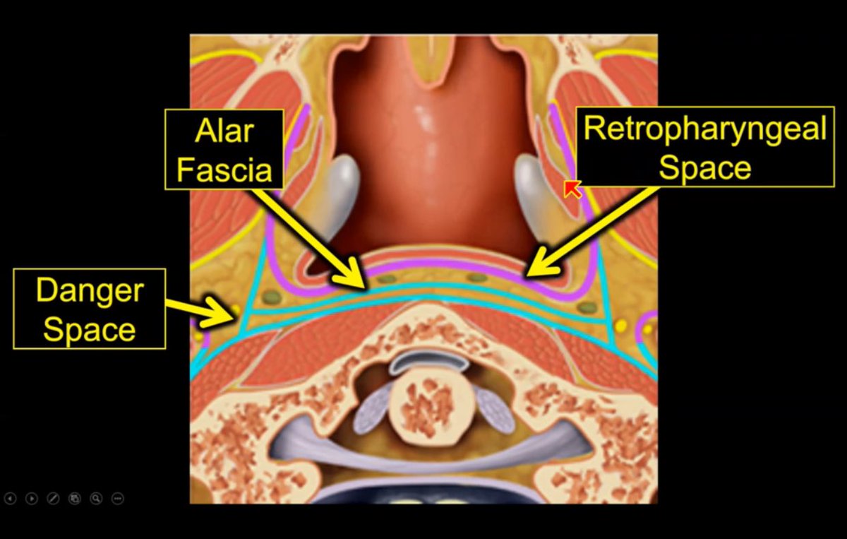#ASHNR20 <a href="/ASHNRSociety/">ASHNR</a> meeting on Head &amp; neck imaging in the virtual space- talks on neck spaces this morning. So engrossed in excellent sessions for the 1st 3 days &amp; now the 4th day is filled with even more learning. What a wonderful talk on neck fascial anatomy by <a href="/rhwiggins/">Richard Wiggins</a>