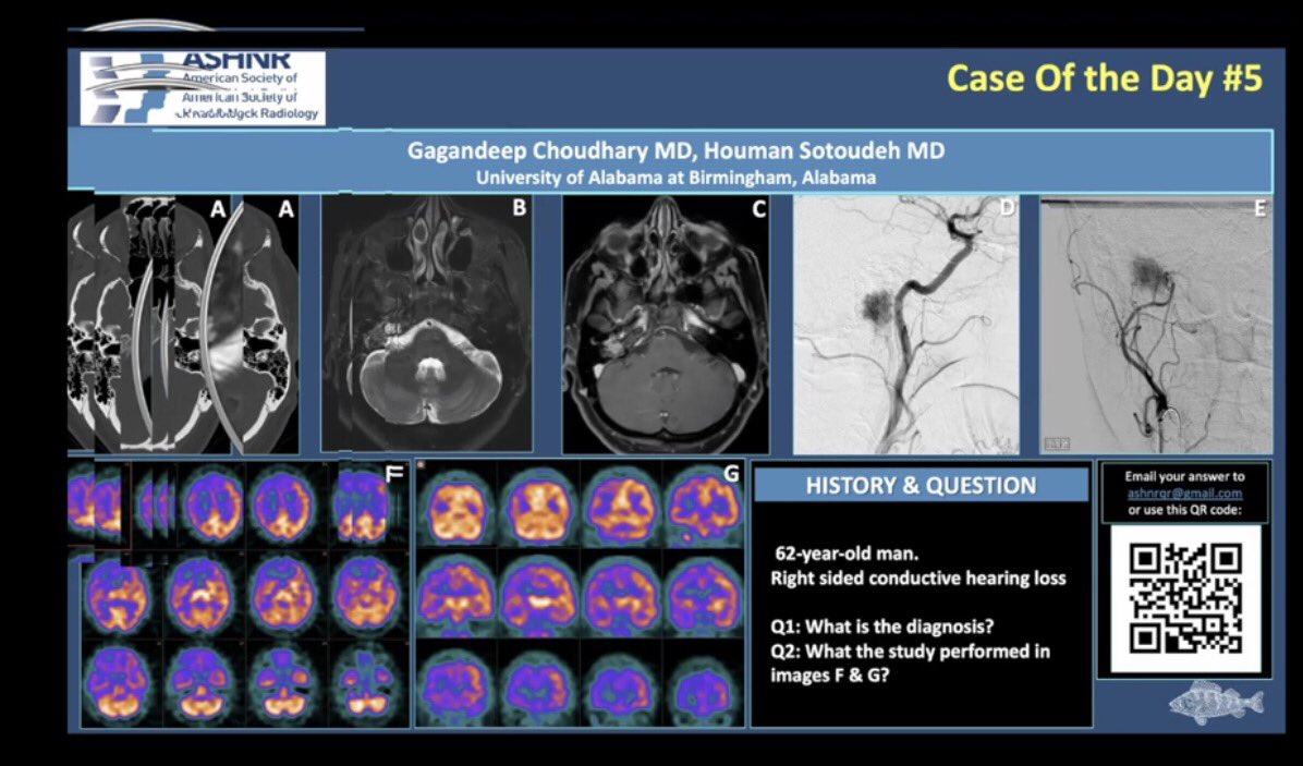 Great case of the day presentations today @ASHNRSociety #ASHNR20. Excellent cases including one by @NeuroradU's @Drgagan1984 @Houmansotoudeh @uabRadResidents! Also love the COD pictures on these 'case of the day' slides. 🐟 @PhilipRChapman1