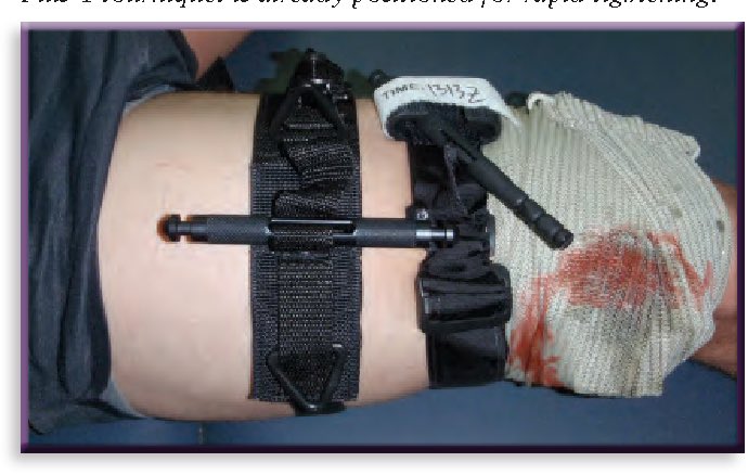 TacTrauma's tweet photo. Tourniquet conversion. Paper by @DocKeenan95 et al   https://t.co/BsLtfoAdK0 @PFCWGMedicine @SpecOpsMedics #TCCC #PFC https://t.co/hpNTSfdtRs