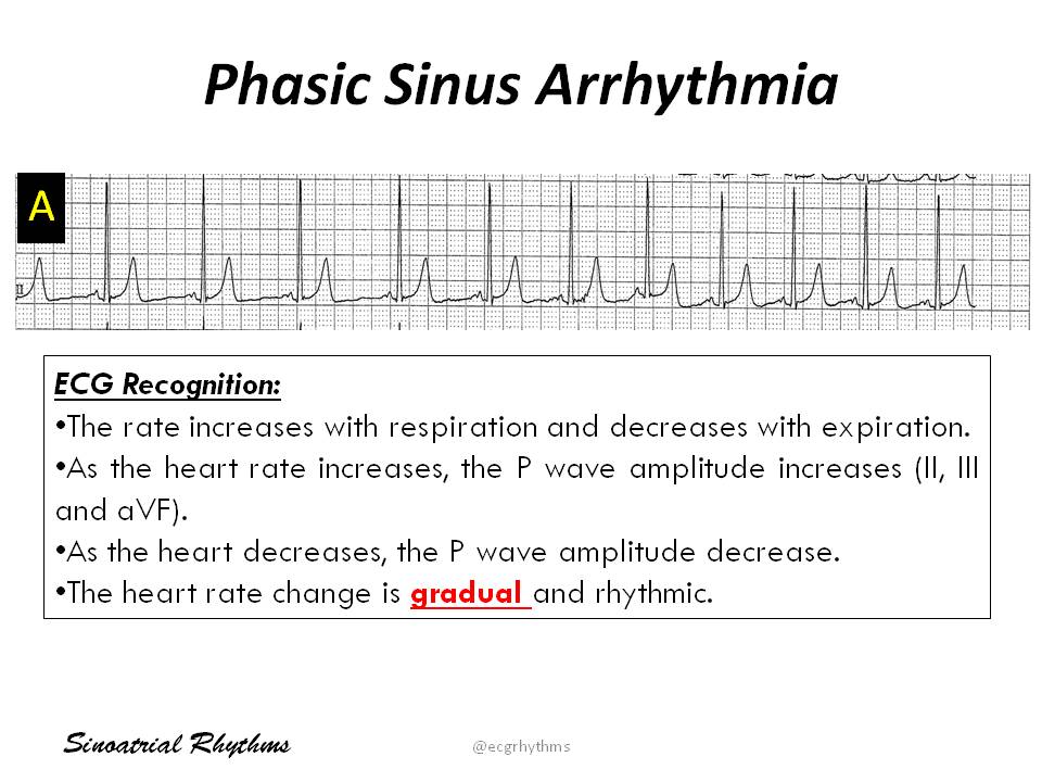 Ecgrhythms Twitterissa Phasic Sinus Arrhythmia Ecg Recognition