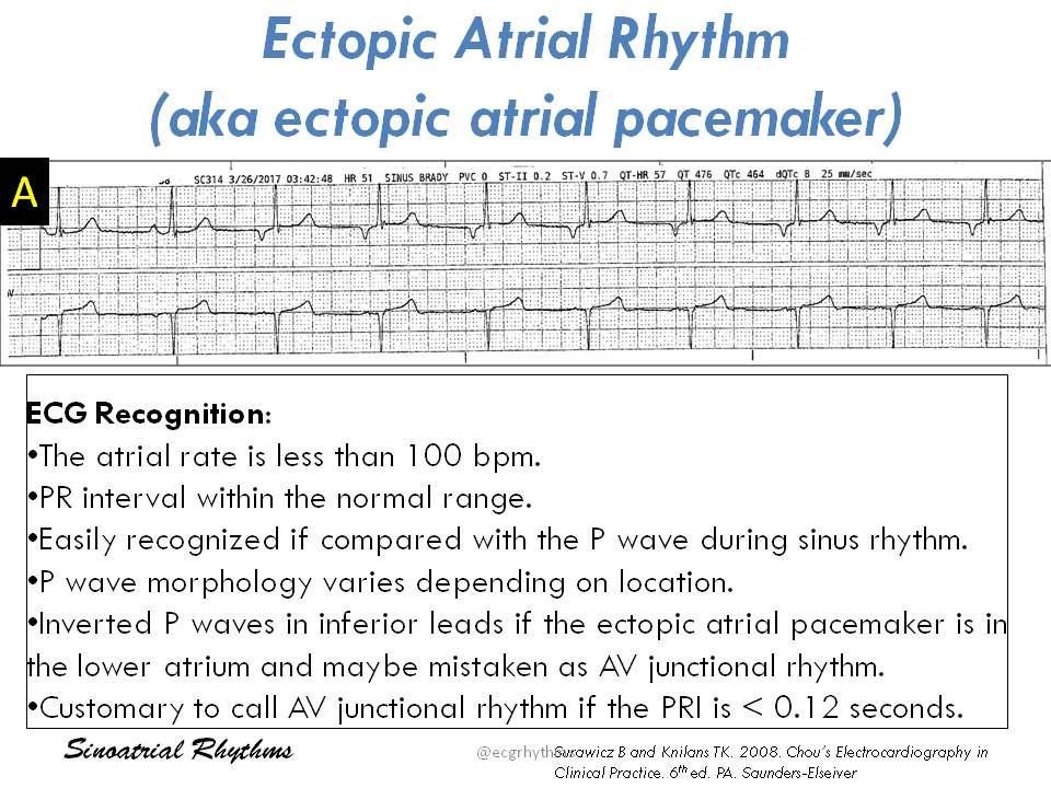 Another Basic Ecg Tweetorial On Sinoatrialrhythms For The Learners Students And Of The Squiggly Lines A Bit Long Feel Free To Add Twitter Thread From Ecgrhythms Arnelc Ecgrhythms Rattibha