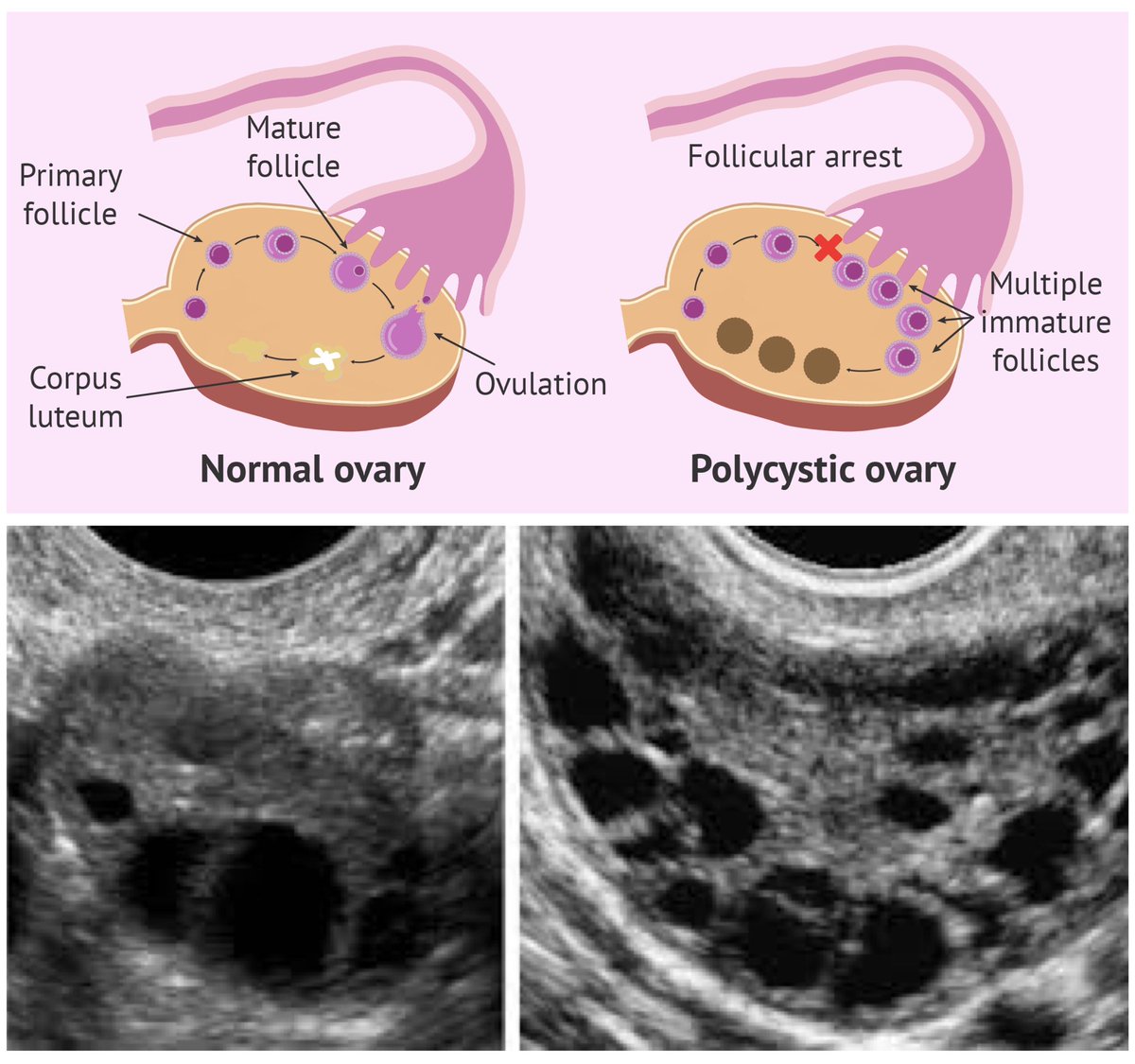 PeakerCysters's tweet photo. The hallmark of PCOS is multiple cysts in the ovaries that look like strings of pearls on ultrasound. (NOTE: It’s possible to have PCOS without cysts &amp; not all cysts mean PCOS.) #PeakerCysters #FightLikeAGirl #PCOSAwarenessMonth #MyPeakChallenge #MPC2020 https://t.co/Xcu1Ce8tqC
