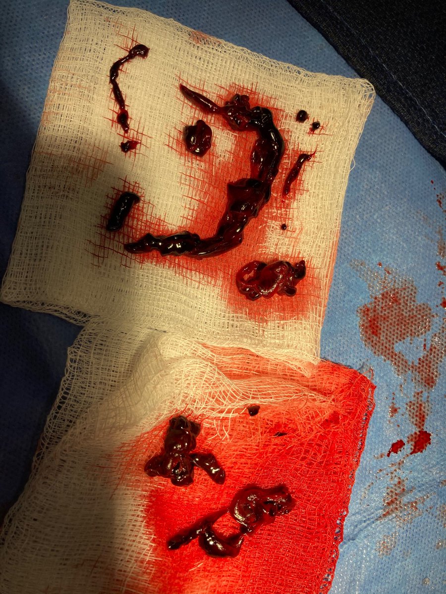 VladLakhter's tweet photo. Special consideration for pts w massive PE requiring VA ECMO and undergoing #Flowtriever ⁦@InariMedical⁩ have to clamp ECMO circuit at different time points to prevent aspirating air into central venous system. #cardiotwitter ⁦@PERTConsortium⁩ ⁦@HadyLichaaMD⁩ https://t.co/BYD5d6Crrw