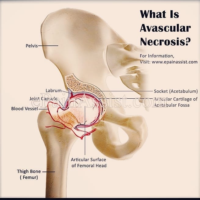 SickleCellMN's tweet photo. Avascular necrosis (AVN), in individuals with sickle  cell disease, results from the temporary or permanent loss of blood supply to the bone in the hip or shoulder joint. This loss of blood causes narrowing of the joint and collapse of the bone.
#SickleCellAwareness #SickleStrong https://t.co/HD6t0qUlZD