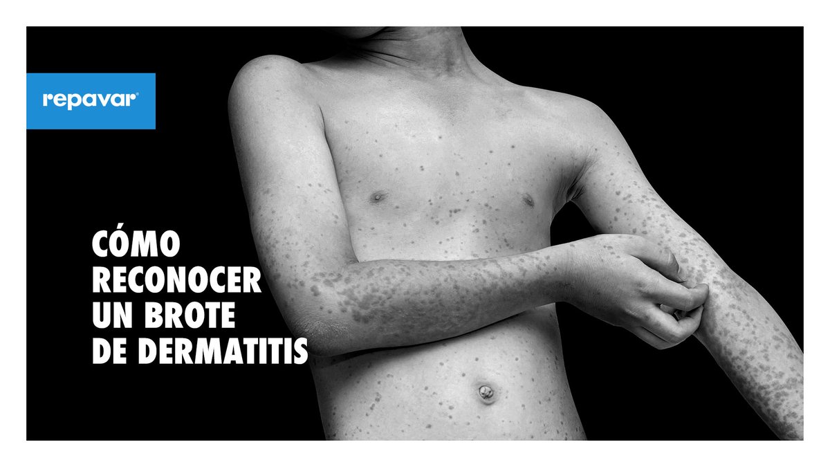 Repavar's tweet photo. - La piel está deshidratada. 
- Tiene áreas enrojecidas e irritadas. 
- Estas zonas pican y se descaman.

La Crema Corporal Extreme de Repavar® combinada con Oleoducha Extreme de Atopic Piel, son el tratamiento específico para el cuidado diario de la piel atópica. https://t.co/eH2Q6e2AfZ