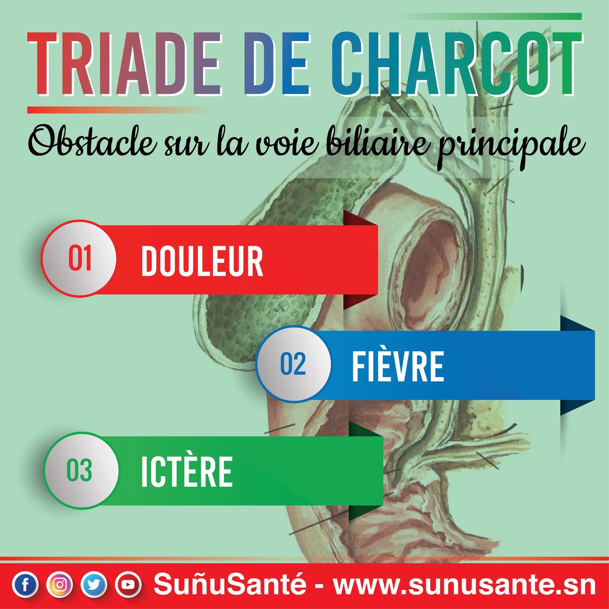 sunusante_sn's tweet image. La Triade chronologique de Charcot ou bien les 3 clochers de Villard et Perrin désignent une septicémie d&apos;origine biliaire secondaire à une infection de la bile en amont d&apos;un Obstacle(calcul+++) sur la voie biliaire principale.

👇🏿👇🏿👇🏿