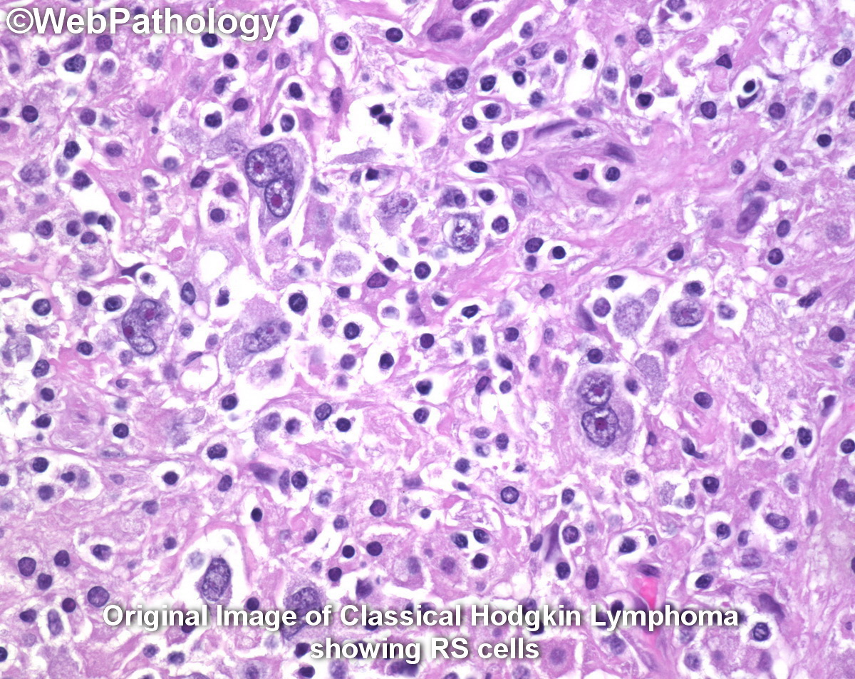 WebPathology's tweet photo. Really proud and honored to share with you that #CanadaPostCorp selected one of my images for a stamp to honor M. Vera Peters, MD, who revolutionized treatment for #HodgkinLymphoma and #breastcancer. Pleasantly surprised yesterday to receive a bunch of stamps and first day covers https://t.co/uXHGhbgyzV