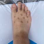 足の表にできた謎の斑点の原因は？？夏特有のものだった!