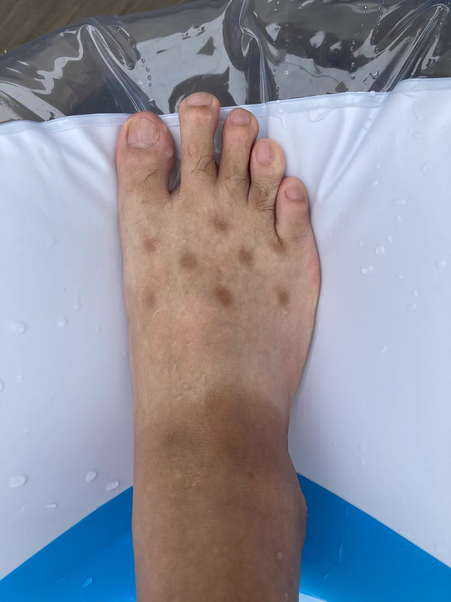 足の表にできた謎の斑点の原因は？？夏特有のものだった！