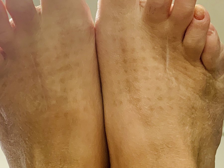先週あたりから足の表にできた謎の斑点 何という病気か調べても一切出てこず悩んでいたら 驚くべき理由が判明