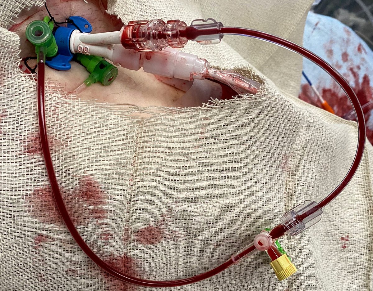 MatthewChungMD's tweet image. Another option for distal perfusion when needed during Impella placement

#cardiotwitter #cardiogenicshock #cathlabhack #impella 

@HadyLichaaMD @kerrigjl @agtruesdell @Babar_Basir @DrAmirKaki @ChomskyDon @bbiglane @Jeanietn @AGoldsweig