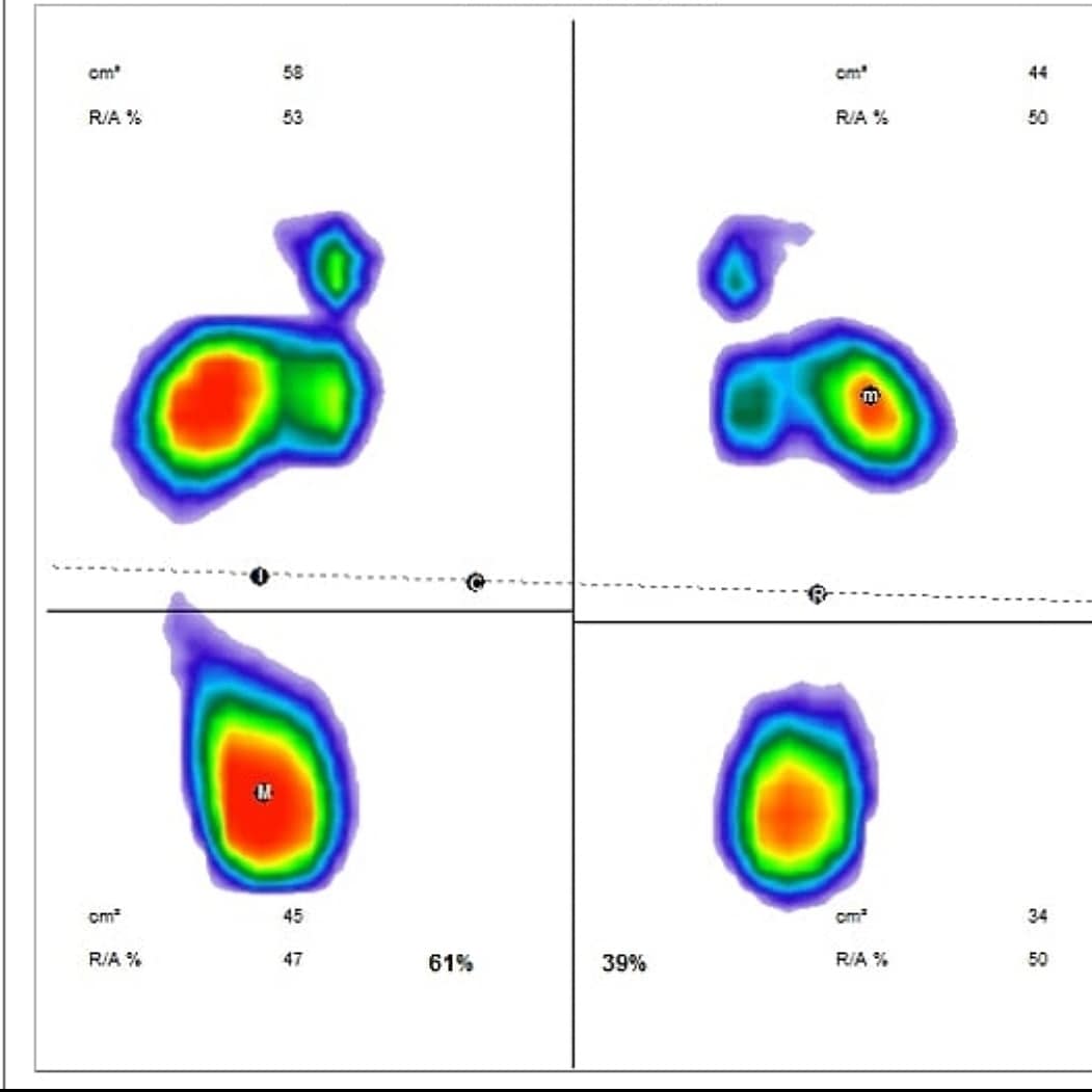 Ferkine's tweet photo. 1- ¿Que tratamiento realizar? 
En este caso utilicé MEP para #tendinopatia #aquileana 
2- Evaluaciones complementarias: utilicé #termografia infrarroja 
#baropodometria diagnóstica
3- Evaluaciones Biomecánica Funcional en 3D, una vez resuelta la lesión y vuelta al deporte. https://t.co/jjtrj0PCZt