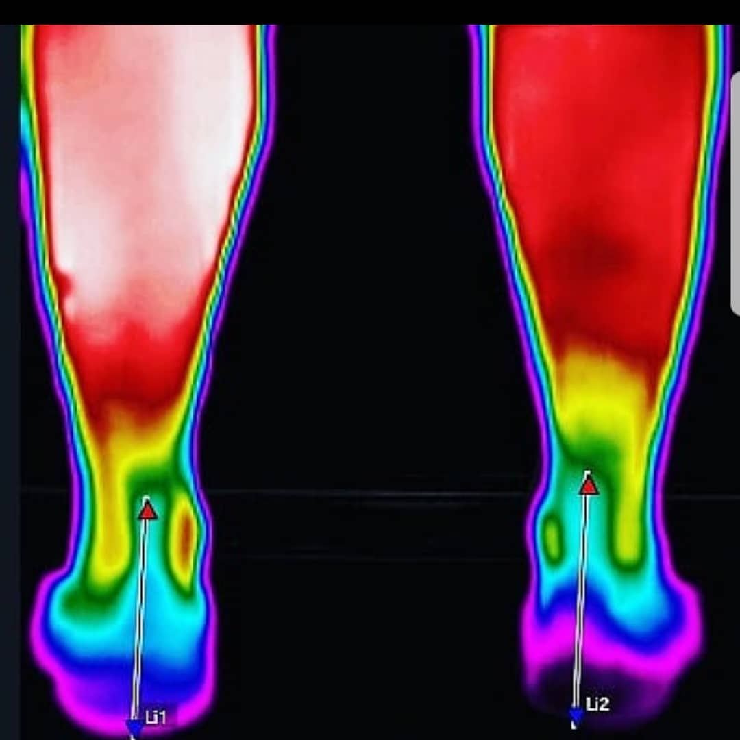 Ferkine's tweet photo. 1- ¿Que tratamiento realizar? 
En este caso utilicé MEP para #tendinopatia #aquileana 
2- Evaluaciones complementarias: utilicé #termografia infrarroja 
#baropodometria diagnóstica
3- Evaluaciones Biomecánica Funcional en 3D, una vez resuelta la lesión y vuelta al deporte. https://t.co/jjtrj0PCZt