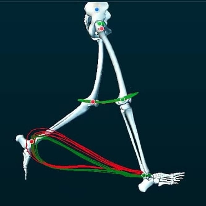 1- ¿Que tratamiento realizar? 
En este caso utilicé MEP para #tendinopatia #aquileana 
2- Evaluaciones complementarias: utilicé #termografia infrarroja 
#baropodometria diagnóstica
3- Evaluaciones Biomecánica Funcional en 3D, una vez resuelta la lesión y vuelta al deporte.