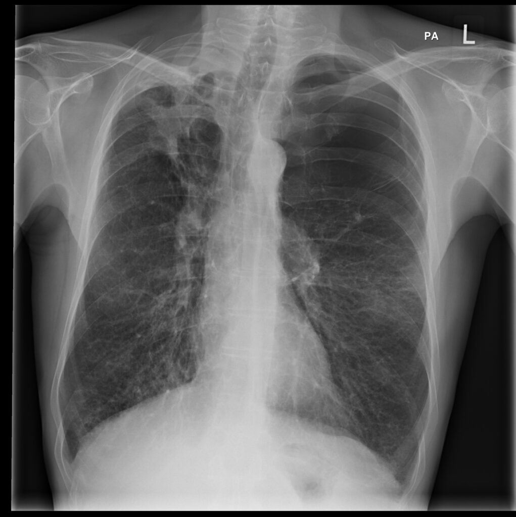 New study finds Invasive aspergillosis (IA) affects up to 2 million people with chronic obstructive pulmonary disease (COPD) globally dlvr.it/RgWkDW