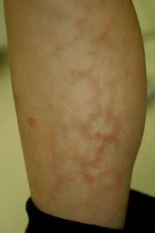 @kenrauheru ちなみにこれは「火ダコ」 と呼ばれるもので、ストーブやこたつなどの暖房器具に長時間当たることでできる温熱紅斑です。 