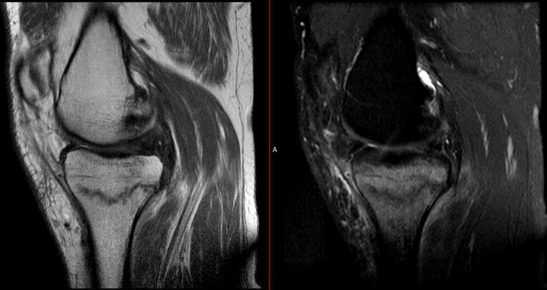Medial tibial plateau stress fracture after returning sports activity after post-covid confinement

Notice also medial meniscus tear

@ulrikita case
#stressfracture #radiology #FOAMrad #MRI #XRay #sports #MSKRad

More pictures in @mskserme Instagram
👇🏼instagram.com/p/CE7cDTgir9x/…