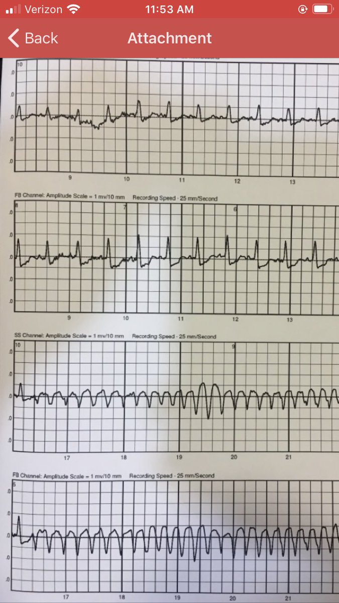 First time for everything! Been in practice for 12 years, and had my first LifeVest outpatient appropriate shock in patient with new cardiomyopathy.  <a href="/bmorecardiology/">Jeremy S. Pollock</a> <a href="/tonkhueMdPhd/">Khue Ton</a>