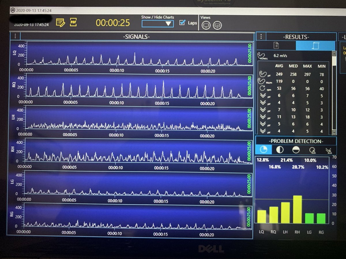 LapuenteManuel's tweet photo. 6 channels #EMG from #Mbody @Myontec_Ltd during:
- frontal step
- double leg ankle hop jumps
- single leg alternate ankle hop jumps
- single leg ankle hop jumps
with chronic left knee pain
Compensations, #asimmetry #quads #hamstrings #glutes #assessment
@SmartPerf https://t.co/bf7tsHSDud