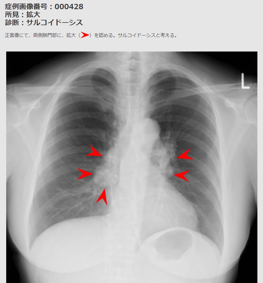Twitter 上的 メディカル指南車 画像診断 一問一答 正解は拡大です 62歳女性のサルコイドーシスの症例です サルコイドーシスは肉芽腫と呼ばれる結節が全身に出現する原因不明の病気で 肺門部のリンパ節などに多く見られます 画像診断 胸部x線
