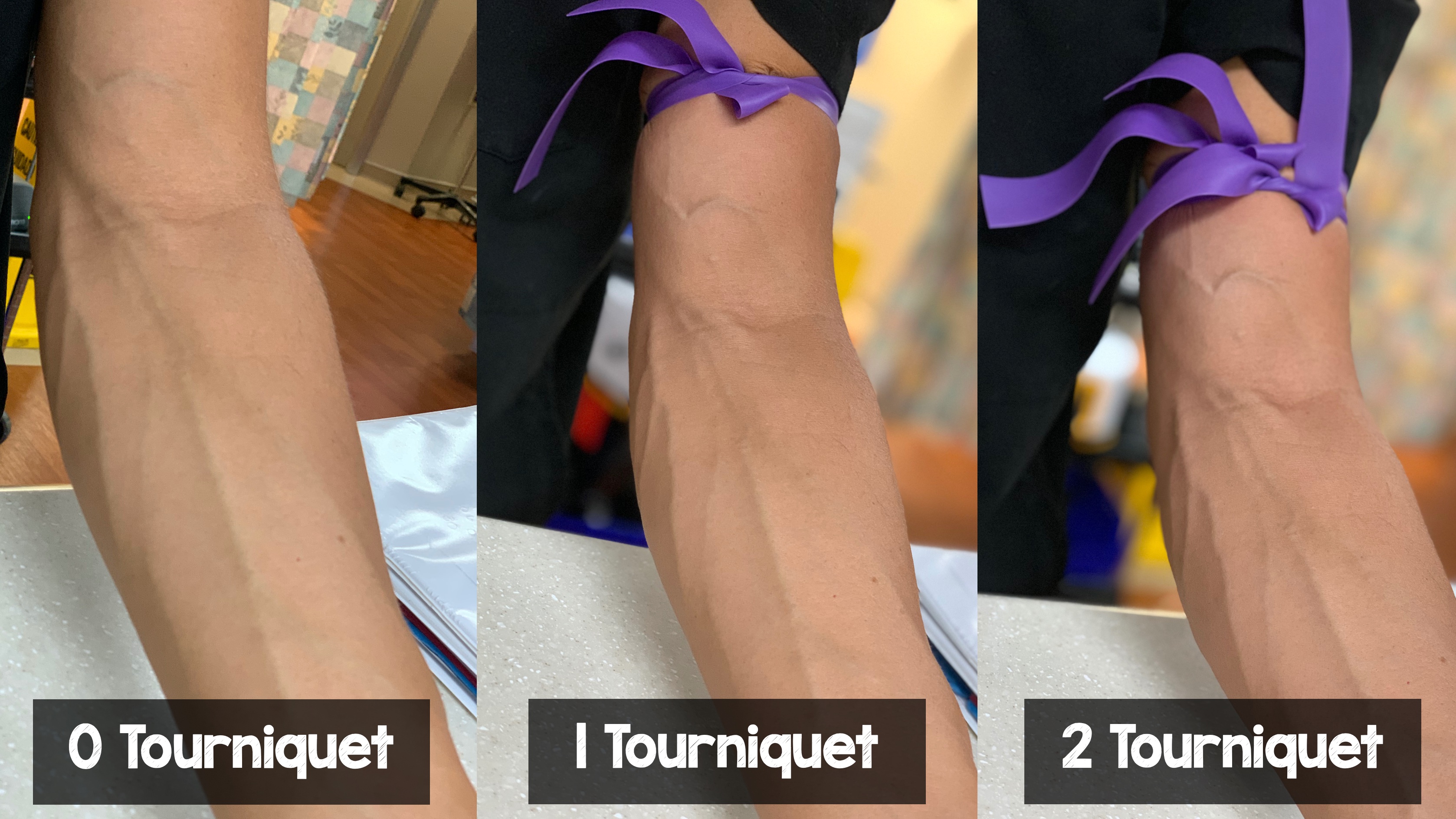 Salim R. Rezaie, MD on Twitter: "Difficult IV Access: Use 2 tourniquets  instead of one...bigger target = better chance of success #FOAMed #FOAMcc  #FOAMus https://t.co/RKg6usVOMt" / Twitter