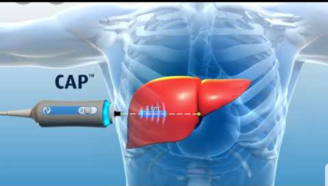 🔴من الخاص ؛ 
⚠️تفسير اختلاف القراءات في فترة قصيره .
◀️من أشهر أسباب( ارتفاع القراءات overestimated بجهاز الفيبرو fibroscan لفحص تليف الكبد ) .
⬅️السمنه .
⬅️ارتفاع انزيمات الكبد. 
⬅️غير صائم .
⬅️استسقاء البطن 
⬅️تعتمد ع المشغل 
#صوت_الطبيب 
#الكبد 
#صحة 
@wedocaresaudi