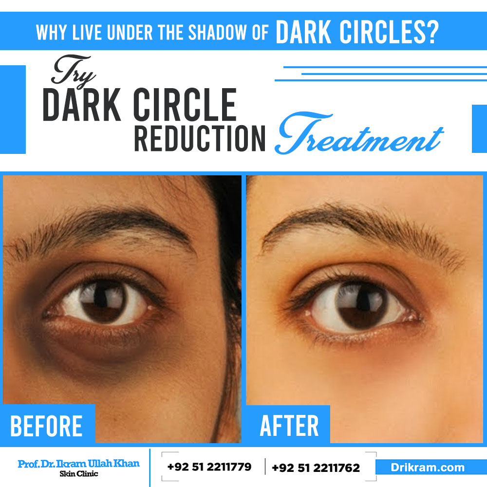 Darkcirclestreatment Hashtag On Twitter