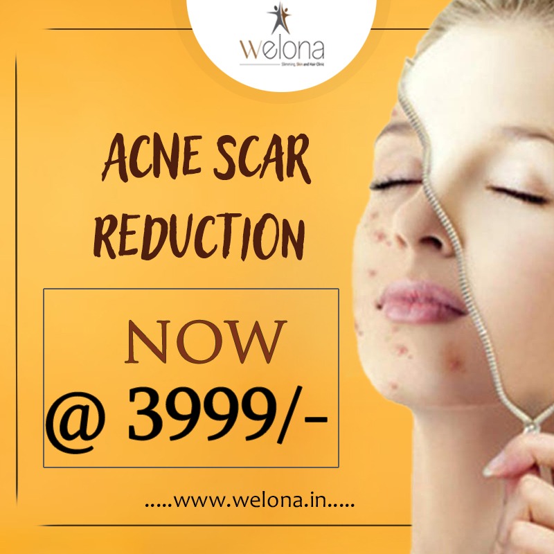 say goodbye to your #Acnescar just @ 3999/-

for more details call - 044 4011 4444

#acnetreatment #skincare #skintreatment #acne #acneremoval #bethenewyou