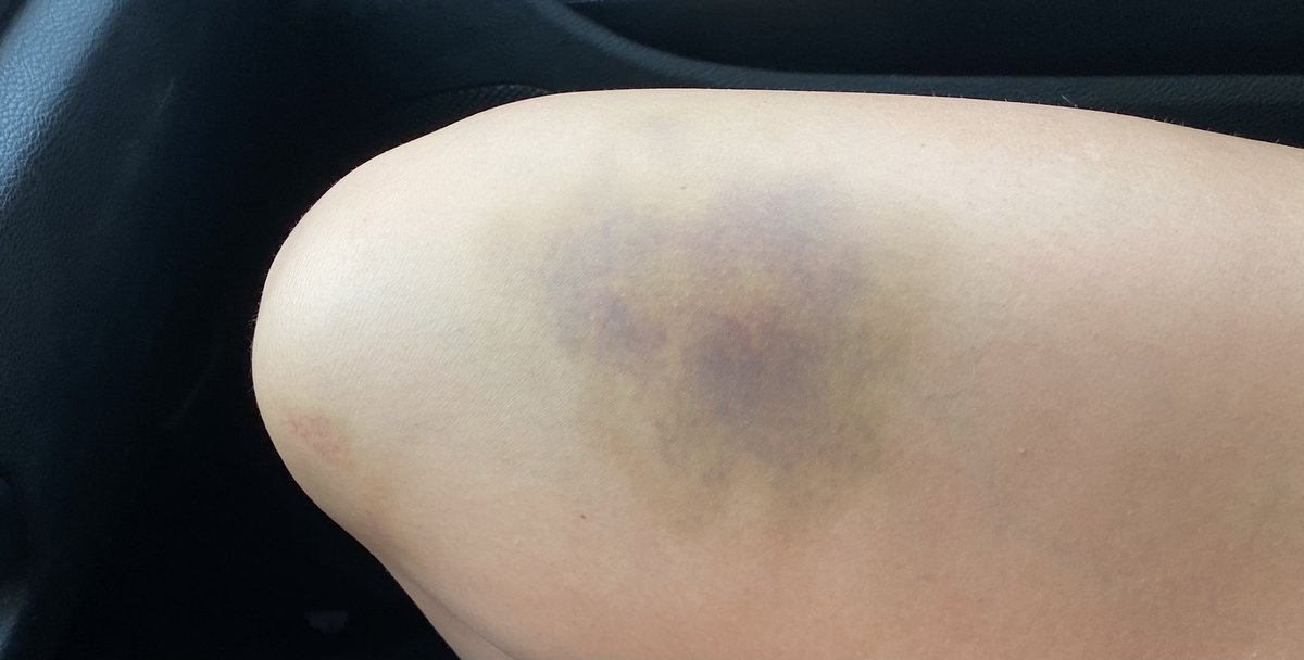 debbie_dgarn's tweet photo. When your daughter’s bruise from the HBP she got at last weekend’s game looks pretty close to the pic from this Thrillist article of outer space! 😎🥎 #softball #science #Solarsystem #trending #takeyourbase https://t.co/hdsUFcIpIY
