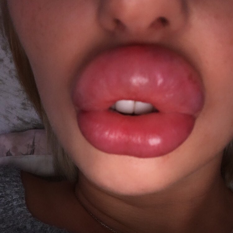 Lipaddictz's tweet photo. @melissaess99 Freshly injected lips, soo big! ππ #fake #lips #lipinjections #plastic #swollen #lipgap #juvederm #filler #addict #lipfetish #plasticsurgery #plasticpositive https://t.co/xaZHwDiqGt