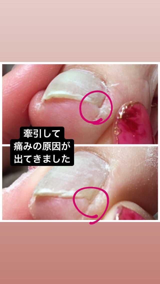 末広町駅 徒歩１分の痛くない巻き爪ケアサロン Makizume Wrnail Twitter
