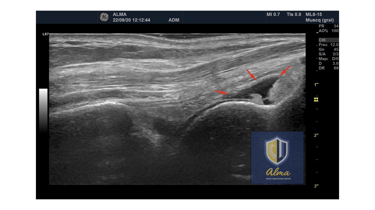 Derrame articular en cuello del astragalo en paciente que presenta limitacion a dorsiflexion de tobillo y dolor en cara anterior del mismo tras esguince.